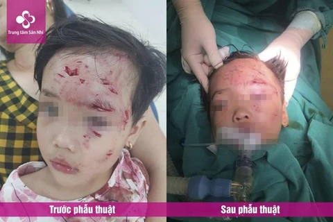 Phú Thọ: Bé gái 3 tuổi bị thương nặng do chó nhà hàng xóm cắn