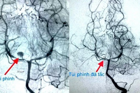 Túi phình mạch máu não trước và sau can thiệp. Ảnh minh họa (Nguồn: Bệnh viện Nhi Đồng 2)