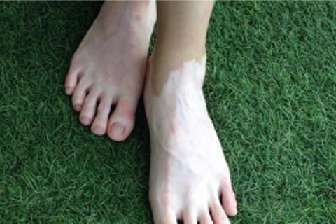 Bàn chân của người mắc bệnh bạch biến. (Ảnh: PV/Vietnam+)
