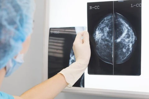Phim chụp X-quang tuyến vú. (Nguồn: Getty Images)
