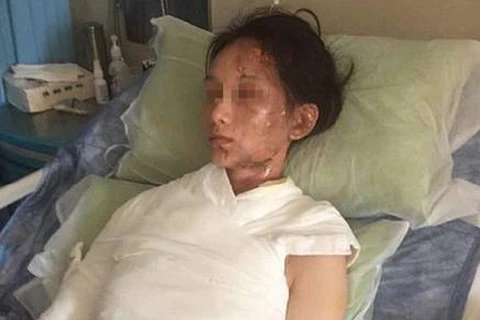 Cô Lin đã bị bỏng 42% cơ thể sau khi bị đổ nước sôi. (Nguồn: CCTV)