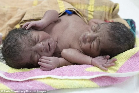 Cặp song sinh dính liền ở Bangladesh. (Nguồn: Daily Mail)
