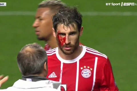 Martinez đổ máu mang chiến thắng về cho Bayern. (Nguồn: BT Sport)