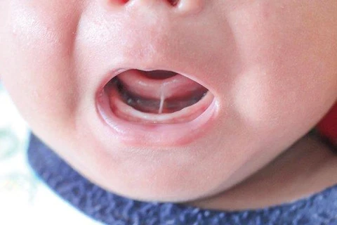 Hàng trăm trẻ bị chậm nói do dị tật dính phanh lưỡi