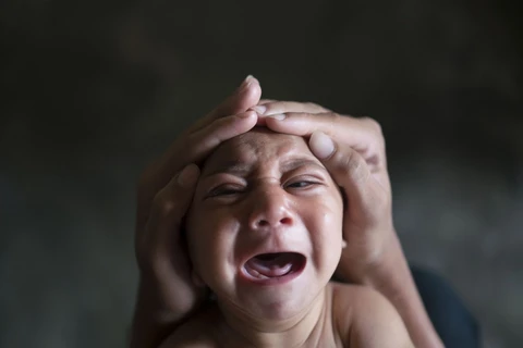 Trẻ bị dị tật đầu nhỏ do virus Zika. (Nguồn: independent.co.uk)