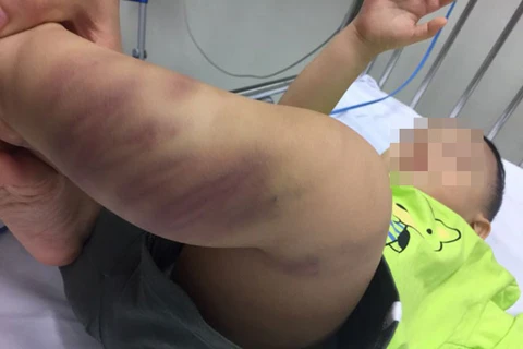 Một bé trai 1 tuổi nghi bị bạo hành, gây thương tích nghiêm trọng 