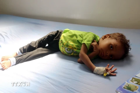 Điều trị cho một em nhỏ suy dinh dưỡng tại bệnh viện ở Sanaa, Yemen. (Nguồn: AFP/TTXVN)