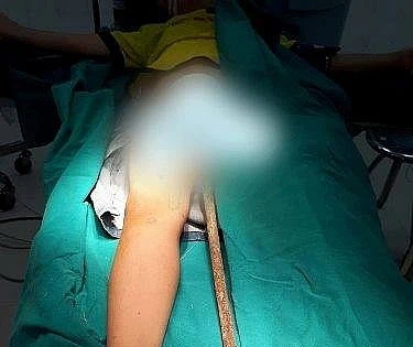 Một bé trai bị thanh sắt đâm xuyên từ bộ phận sinh dục lên bụng