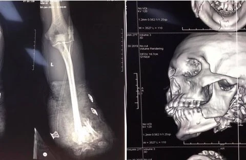 Hình ảnh X-quang về thương tích của nạn nhân.