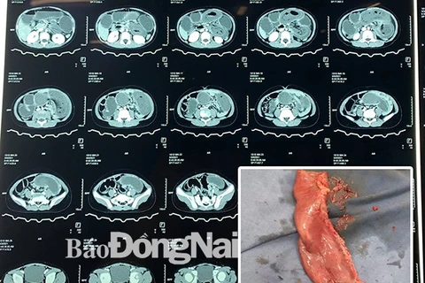 Phim chụp cắt lớp vi tính ổ bụng của bệnh nhân và đoạn ruột chứa polyp được các bác sỹ phẫu thuật cắt bỏ. (Nguồn: Báo Đồng Nai)