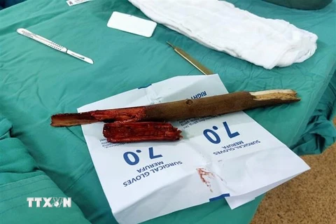 Cành cây đâm vào cổ bệnh nhân N.Q.K, ngụ phường 11, thành phố Vũng Tàu được các bác sỹ Bệnh viện Vũng Tàu phẫu thuật lấy ra từ cổ bệnh nhân. (Ảnh: TTXVN phát)