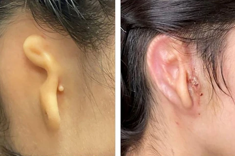 Tai của một bệnh nhân trước khi phẫu thuật (trái) và 30 ngày sau khi phẫu thuật. (Nguồn: NYtimes)