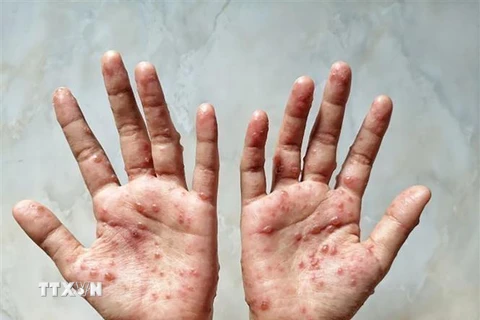 Các ban đỏ nổi trên tay một bệnh nhân mắc bệnh đậu mùa khỉ. (Ảnh: Shutterstock/TTXVN)
