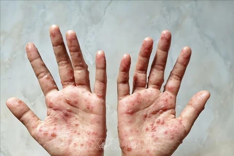 Các ban đỏ nổi trên tay một bệnh nhân mắc đậu mùa khỉ. (Ảnh: Shutterstock/TTXVN)