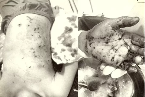 Hình ảnh các tổn thương của bệnh nhi sau vụ nổ pin đồ chơi. (Ảnh: Bệnh viện cung cấp)