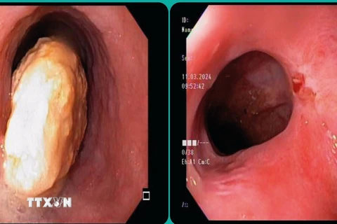 Khối dị vật chiếm gần hết lòng thực quản và lòng thực quản sau khi dị vật đã được lấy ra. (Ảnh: TTXVN phát)