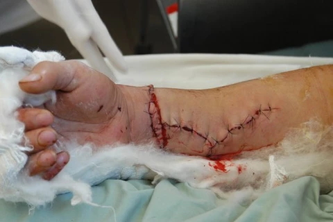Lâm Đồng: Phẫu thuật thành công cánh tay bị khỉ cắn nát