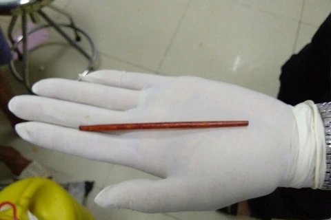 Gắp thành công chiếc đũa dài 12cm trong dương vật một bệnh nhân
