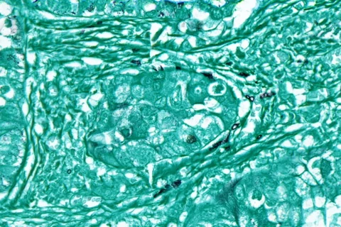 Phát hiện dấu vết của nhiều loại nấm trong các khối u ung thư 