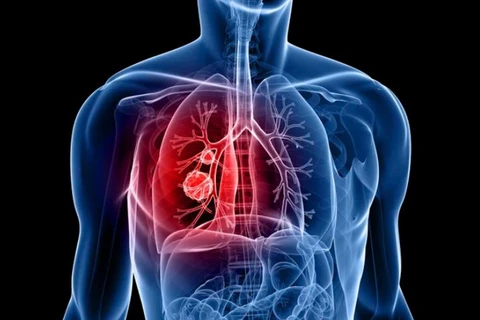 Ung thư phổi là một trong 10 căn bệnh ung thư phổ biến nhất thế giới. (Nguồn: cityofhope.org)