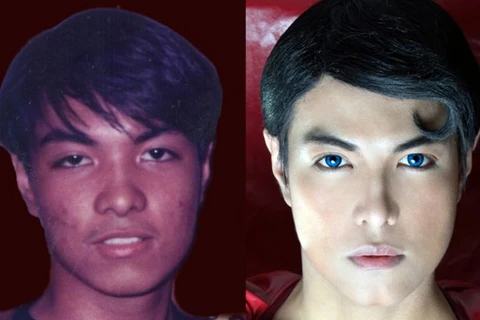 Hình ảnh của Herbert Chavez trước và sau khi phẫu thuật. (Nguồn: Daily Mail)