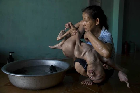 Trần Thiện Nhân, một nạn nhân của chất độc màu da cam ở Đà Nẵng, Việt Nam.