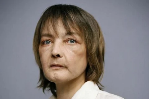 Chị Isabelle Dinoire, người đầu tiên trên thế giới được phẫu thuật cấy ghép mặt. (Nguồn: telegraph.co.uk) 