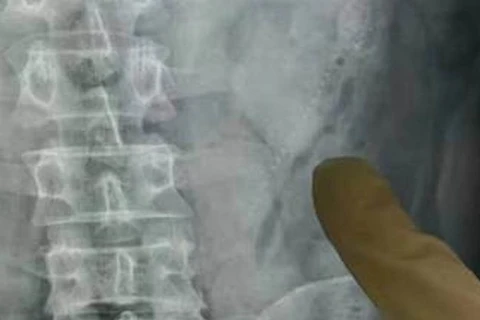 Bác sỹ chụp x-quang để xác định vị trí hai con lươn. (Nguồn: mirror.co.uk)