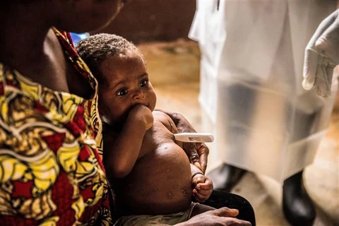 Bệnh nhân mắc đậu mùa khỉ được điều trị tại trung tâm cách ly ở Zomea Kaka thuộc vùng Lobaya (Cộng hòa Trung Phi), ngày 18/10/2018. (Ảnh: AFP/TTXVN)