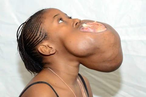 Cô gái có khối u bằng quả bóng ở miệng được phẫu thuật 