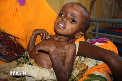 Trẻ em Somali bị suy dinh dưỡng điều trị tại bệnh viện ở Mogadishu. (Nguồn: AFP/TTXVN)