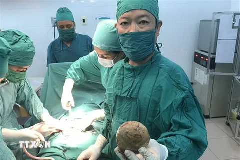 Êkíp bác sỹ Bệnh viện đa khoa khu vực Định Quán phẫu thuật lấy viên sỏi "khủng" cho bệnh nhân. (Ảnh: Lê Xuân/TTXVN)