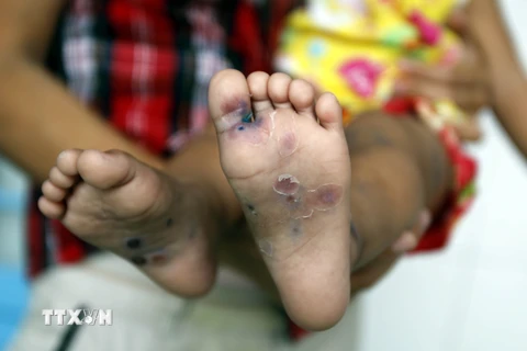 Một trẻ mắc bệnh tay chân miệng. (Ảnh: TTXVN/Vietnam+)