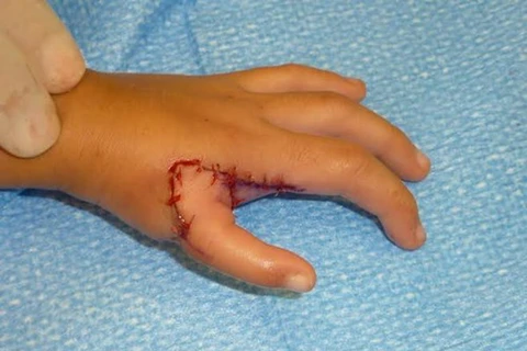 Bàn tay bé Linh sau khi được phẫu thuật. (Ảnh: H.Minh/Vietnam+) 