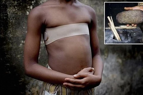 Một bé gái bị ép phẳng ngực bằng đá nóng. (Nguồn: QQ News)