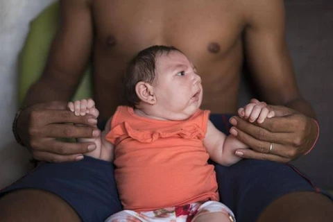 Một bé gái ở Brazil bị mắc chứng đầu nhỏ. (Nguồn: AP)