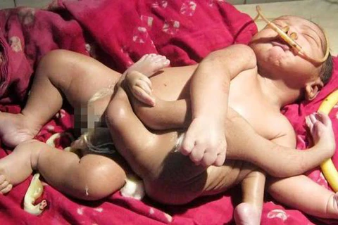 Em bé "con của thần linh" có 4 chân 4 tay ra đời ở Ấn Độ