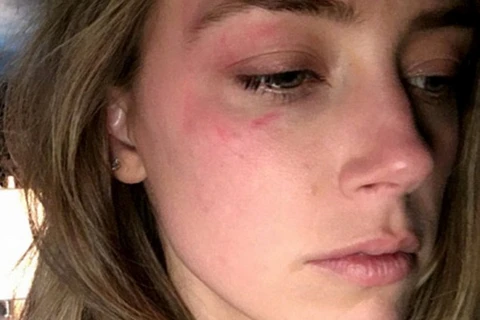 Bức ảnh nữ diễn viên Amber Heard đăng tải với những vết bầm tím trên mặt. (Nguồn: dailymail.co.uk)