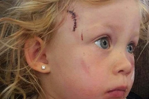 Bé gái gặp phải tai nạn kinh hoàng do bị ngăn kéo tủ rơi vào đầu. (Nguồn: Thesun.co.uk)