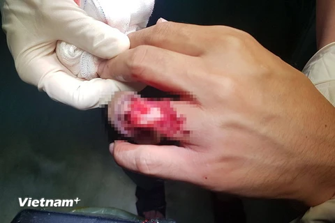 Ngón tay bị tai nạn. (Nguồn: Vietnam+)