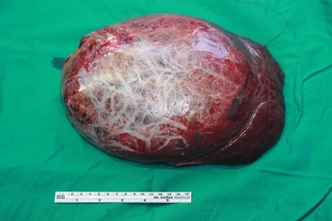 Cắt bỏ khối u máu gan khổng lồ kích thước 30cm cho bệnh nhân 59 tuổi