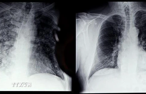 Phim chụp Xquang phổi của bệnh nhân COVID-19 (trái) và phổi của người bình thường tại bệnh viện ở Magdeburg, miền đông nước Đức, ngày 28/4/2021. (Ảnh: AFP/ TTXVN)