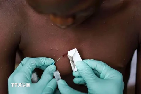 Nhân viên y tế điều trị cho một bệnh nhân mắc bệnh đậu mùa khỉ tại Nigeria. (Ảnh: Getty Images/TTXVN)