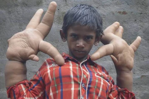 Cậu bé 8 tuổi người Ấn Độ bị xa lánh vì có đôi tay "khổng lồ"