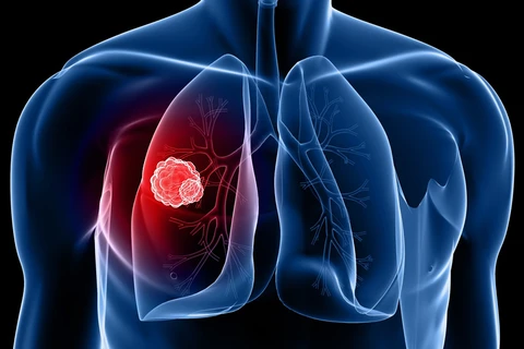 Thử nghiệm phương pháp điều trị ung thư phổi bằng tế bào gốc