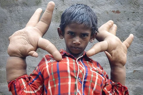 Cậu bé người Ấn Độ có bàn tay khổng lồ. (Nguồn: Daily Mail)