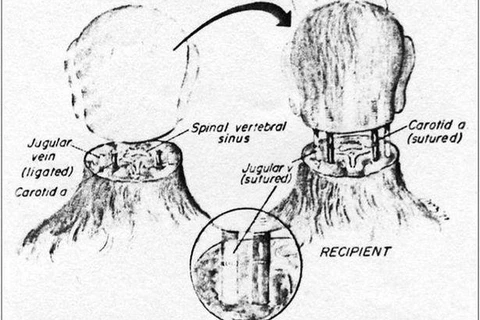 Người được ghép đầu sẽ phải đối mặt cảm giác tồi tệ hơn cái chết