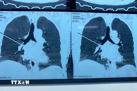 Hình ảnh chụp X quang nơi mảnh xương còn nằm trong phế quản của bệnh nhân. (Ảnh: TTXVN phát)