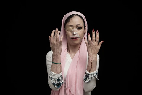 Shirin Mohamadi (18 tuổi) ở Tehran, Iran đã nói không với người cầu hôn cô. Người đàn ông trên đã quyết định dùng axít để tấn công cô vào năm 2012. Sau vụ tấn công kinh hoàng, Shirin bị mất mắt phải, mũi , miệng, tai và một số bộ phận trên cơ thể của cô b