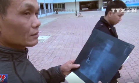 [Video] Bác sỹ để quên kéo trong bụng bệnh nhân suốt 18 năm